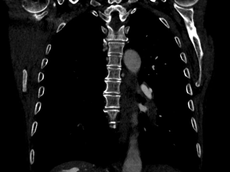 File:Chronic pulmonary embolism (Radiopaedia 91241-108843 A 74).jpg