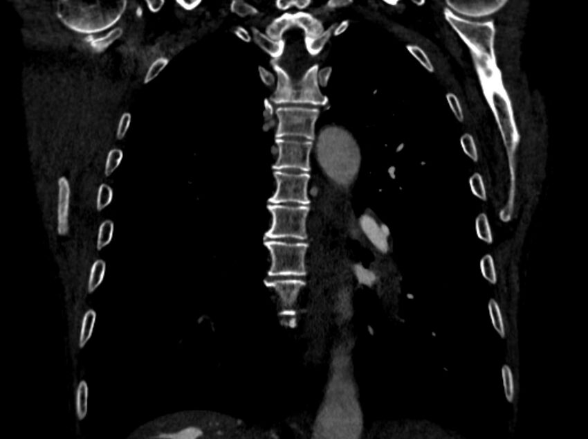 Chronic pulmonary embolism (Radiopaedia 91241-108843 A 74).jpg