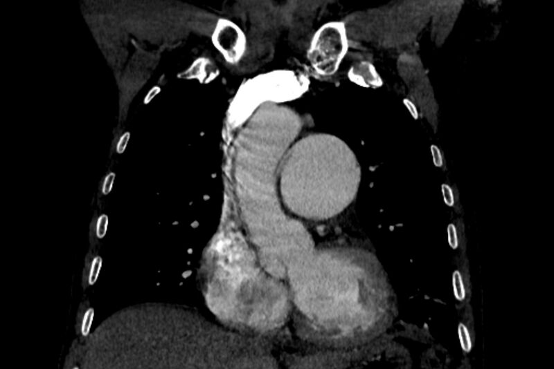 File:Chronic pulmonary embolism with bubbly consolidation (Radiopaedia 91248-108850 B 53).jpg