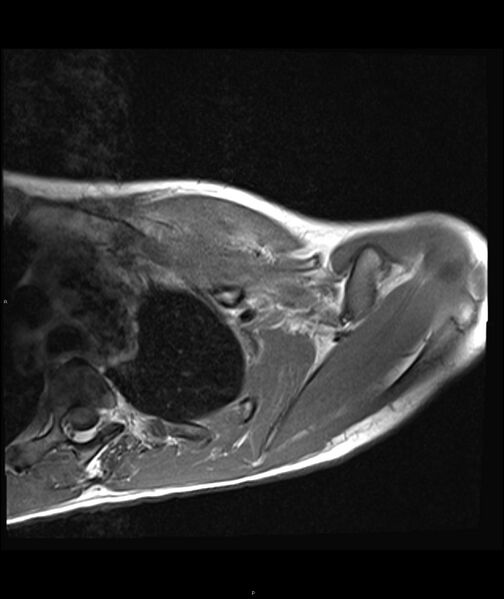 File:Chronic reactive multifocal osteomyelitis (CRMO) - clavicle (Radiopaedia 56406-63071 Axial T1 12).jpg