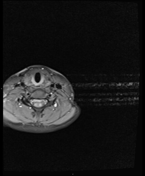 File:Chronic reactive multifocal osteomyelitis (CRMO) - clavicle (Radiopaedia 56406-63114 Axial T1 fat sat 1).jpg