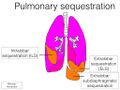 Classification of pulmonary sequestration (Radiopaedia 53503).jpeg