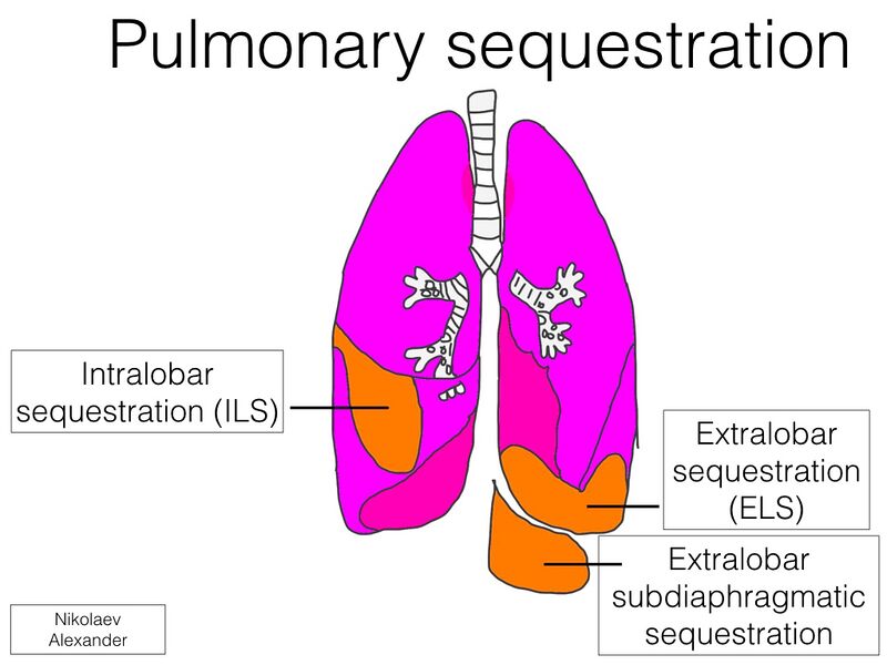 File:Classification of pulmonary sequestration (Radiopaedia 53503).jpeg