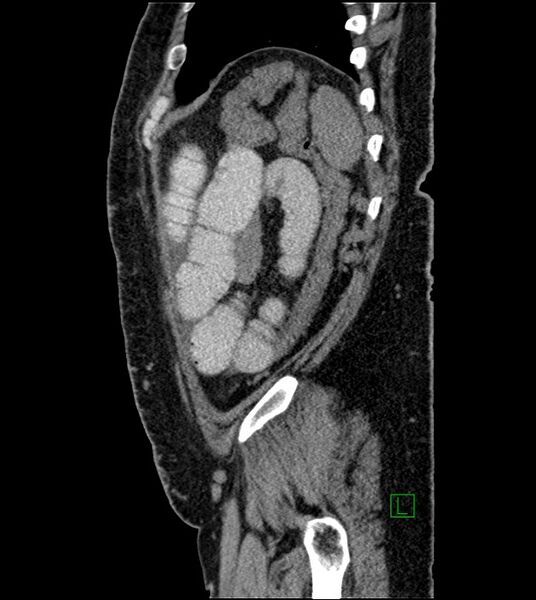 File:Closed-loop small bowel obstruction-internal hernia (Radiopaedia 78439-91096 C 31).jpg