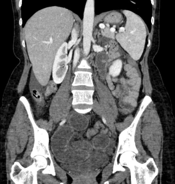 File:Closed loop small bowel obstruction (Radiopaedia 71211-81508 B 70).jpg