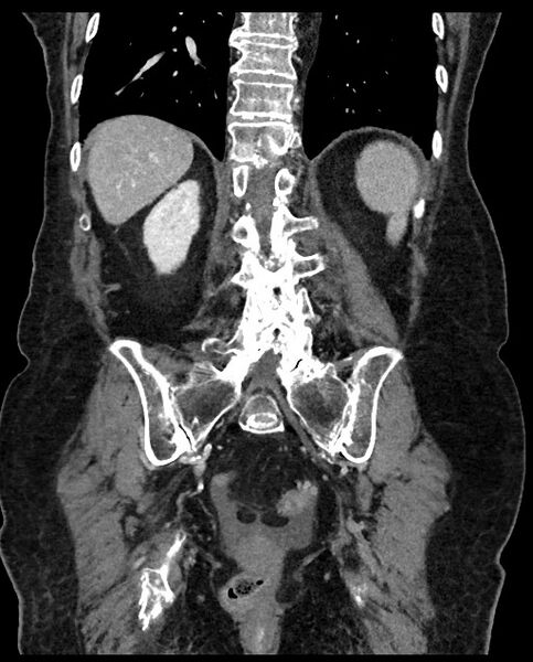 File:Closed loop small bowel obstruction - adhesions (Radiopaedia 59269-66611 B 93).jpg