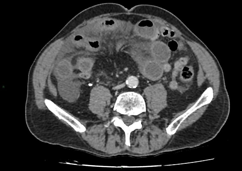 Closed loop small bowel obstruction with ischemia (Radiopaedia 84180-99456 A 72).jpg