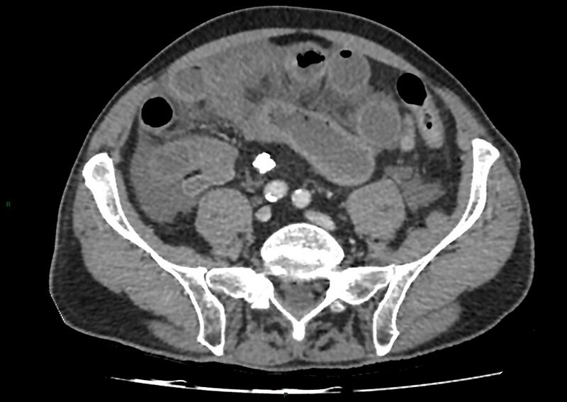 File:Closed loop small bowel obstruction with ischemia (Radiopaedia 84180-99456 A 83).jpg