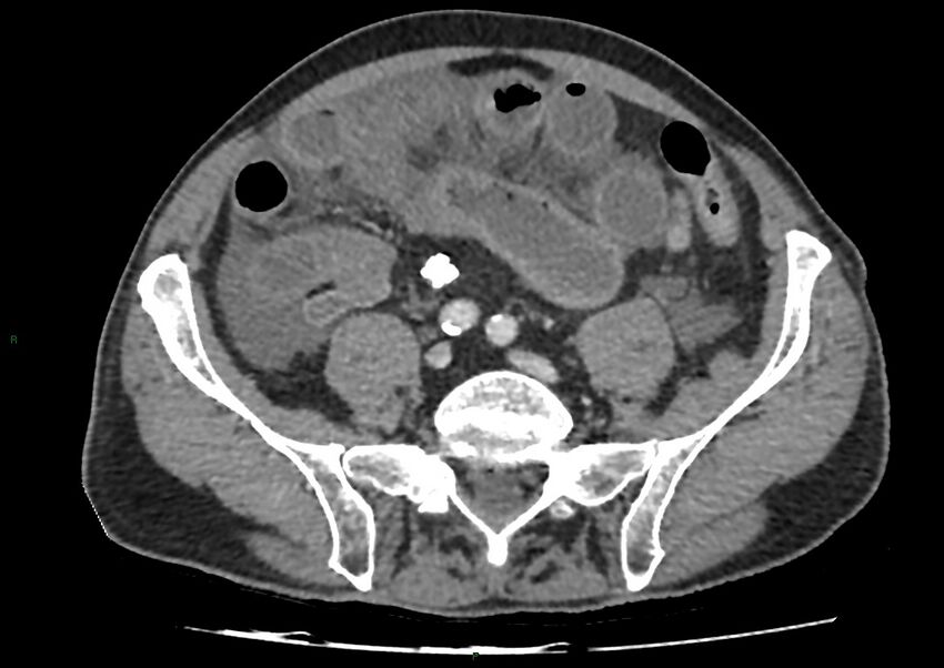 Closed loop small bowel obstruction with ischemia (Radiopaedia 84180-99456 A 83).jpg