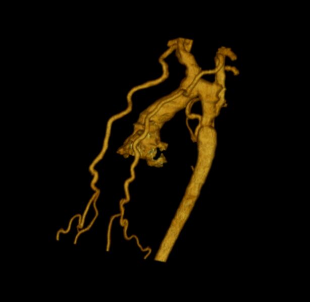 File:Coarctation of the aorta (Radiopaedia 6279-7684 3D rotation 4).jpg