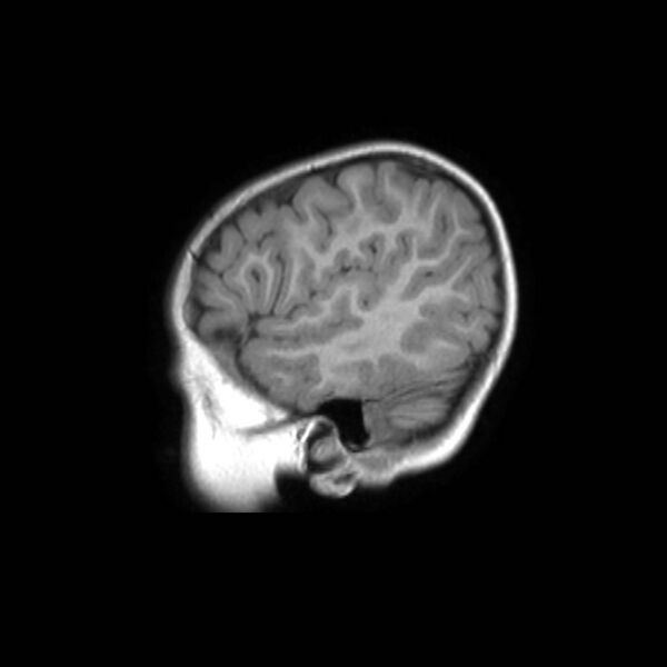 File:Cochlear nerve aplasia - unilateral (Radiopaedia 87910-104413 Sagittal T1 9).jpg