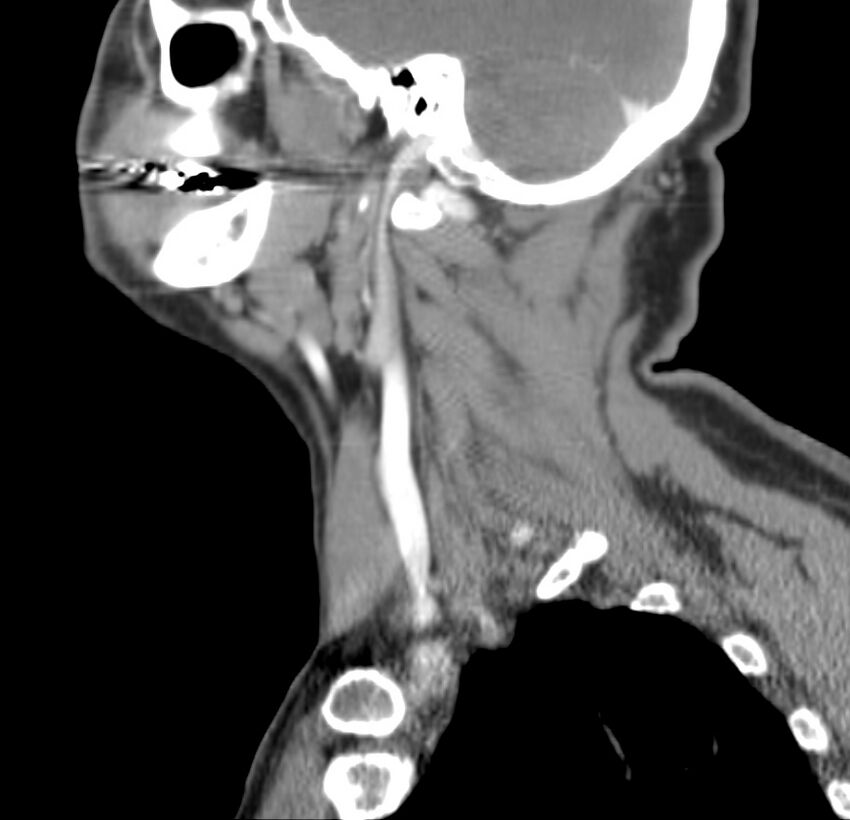 Colloid cyst of thyroid (Radiopaedia 22897-22923 Sagittal C+ delayed 42).jpg