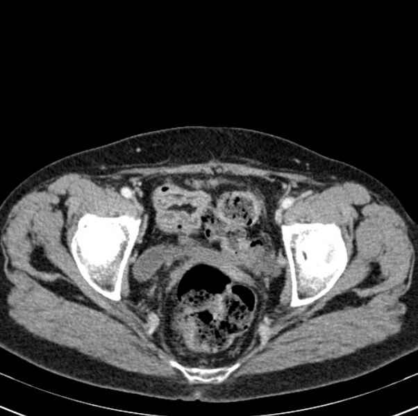 File:Colon carcinoma with hepatic metastases (Radiopaedia 29477-29961 A 104).jpg