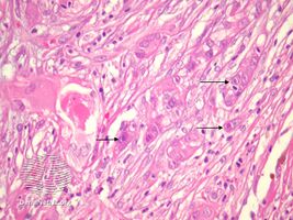 pathology-Proliferating trichilemmal cyst
