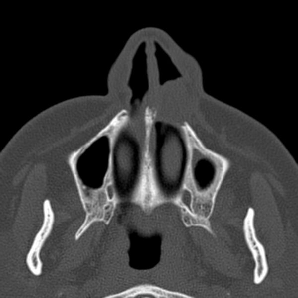 File:Nasolabial cyst (Radiopaedia 33987-35205 Axial bone window 9).jpg