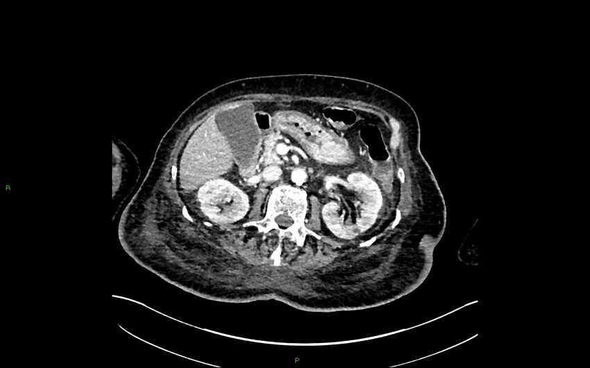 Neo-terminal ileal stricture (Crohn disease) (Radiopaedia 33790-34948 A 159).jpg