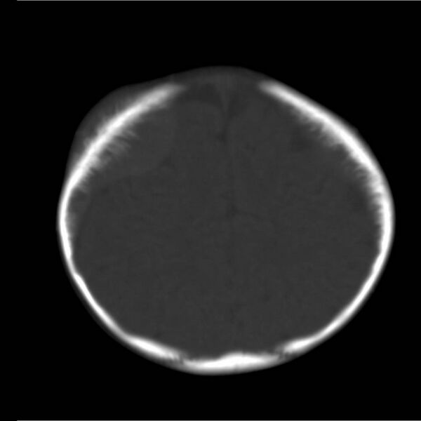 File:Neuroblastoma with skull metastases (Radiopaedia 30326-30958 Axial bone window 18).jpg