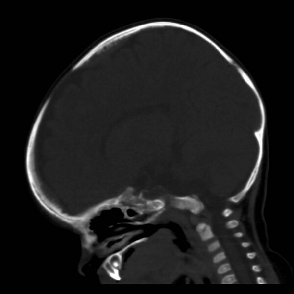 File:Neuroblastoma with skull metastases (Radiopaedia 30326-30958 Sagittal bone window 18).jpg