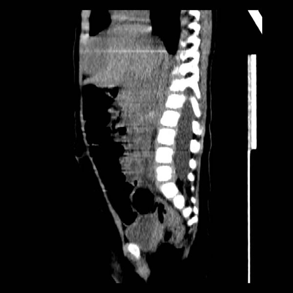 File:Neuroblastoma with skull metastases (Radiopaedia 30326-30960 B 21).jpg