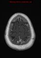 Neuroglial cyst (Radiopaedia 10713-11184 Axial T1 C+ 3).jpg