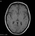 Neurosarcoidosis (Radiopaedia 10930-17204 Axial T1 10).jpg