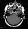Neurosarcoidosis (Radiopaedia 10930-17204 Axial T1 C+ 4).jpg