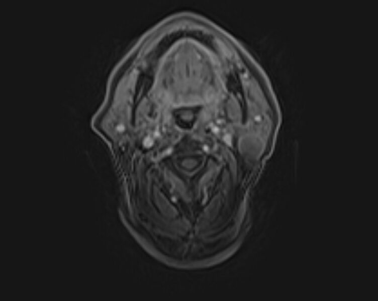 File:Non-Hodgkin lymphoma - parotid gland (Radiopaedia 71531-81890 E 34).jpg