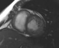 Non-compaction of the left ventricle (Radiopaedia 69436-79314 Short axis cine 123).jpg
