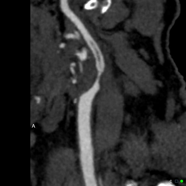 File:Non-occlusive intraluminal internal carotid artery thrombus (Radiopaedia 37751-39658 A 51).jpg