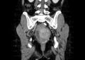 Non-puerperal uterine inversion (Radiopaedia 78343-91094 B 43).jpg