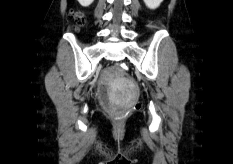 File:Non-puerperal uterine inversion (Radiopaedia 78343-91094 B 43).jpg