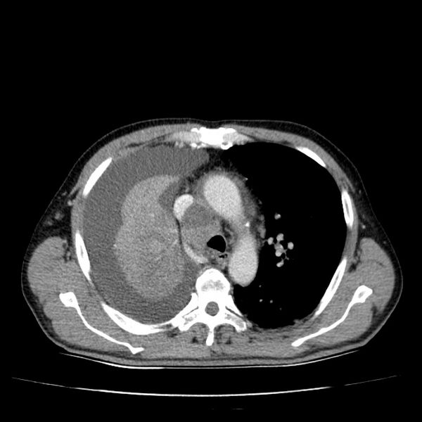 File:Non small-cell lung cancer (Radiopaedia 24467-24769 C+ delayed 23).jpg