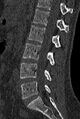Normal CT lumbar spine (Radiopaedia 53981-60118 Sagittal bone window 51).jpg
