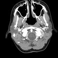 Normal CT of the neck (Radiopaedia 14575-14500 Axial C+ 19).jpg
