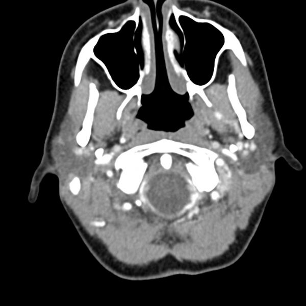 File:Normal CT of the neck (Radiopaedia 14575-14500 Axial C+ 19).jpg