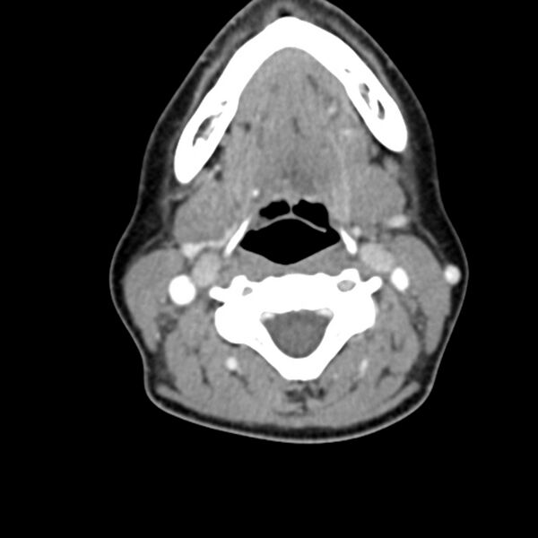 File:Normal CT of the neck (Radiopaedia 14575-14500 Axial C+ 36).jpg
