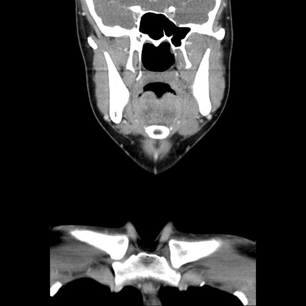 File:Normal CT of the neck (Radiopaedia 14575-14500 Coronal C+ 20).jpg