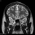 Normal coronal brain (Radiopaedia 6676-7910 Coronal T2 10).jpg