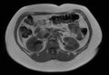 Normal liver MRI with Gadolinium (Radiopaedia 58913-66163 Axial T1 in-phase 13).jpg