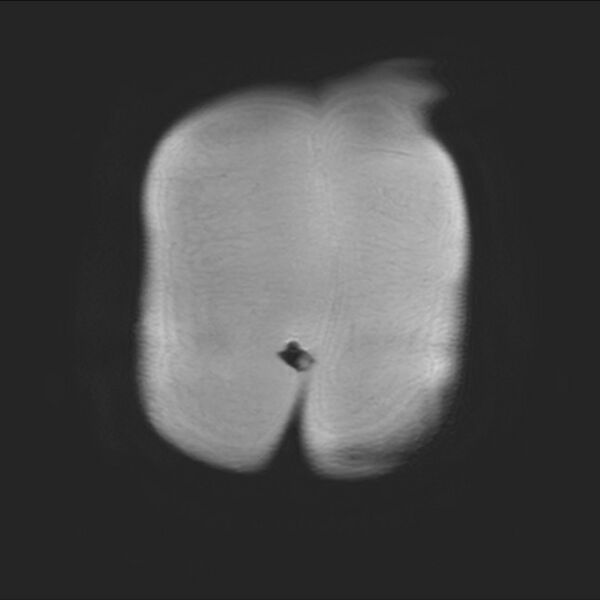 File:Normal liver MRI with Gadolinium (Radiopaedia 58913-66163 Coronal T2 2).jpg