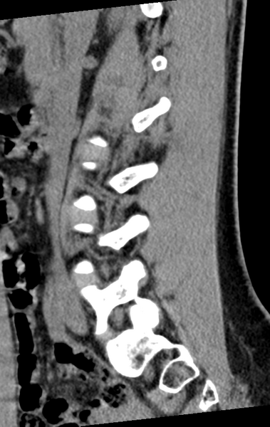 File:Normal lumbar spine CT (Radiopaedia 46533-50986 C 67).png