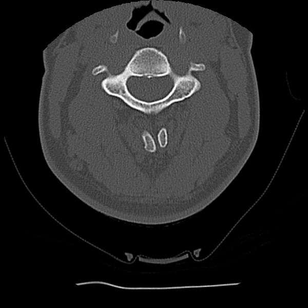 File:Normal trauma spine imaging (Radiopaedia 31753-32686 Axial bone window 30).jpg