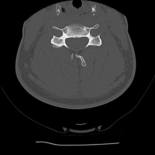 File:Normal trauma spine imaging (Radiopaedia 31753-32686 Axial bone window 45).jpg