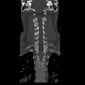 Occipital condyle fracture (Radiopaedia 31755-32691 Coronal bone window 20).jpg