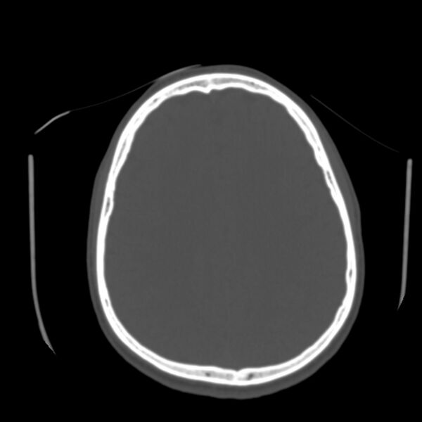 File:Occipital spur - asymptomatic (Radiopaedia 87753-104201 Axial bone window 138).jpg