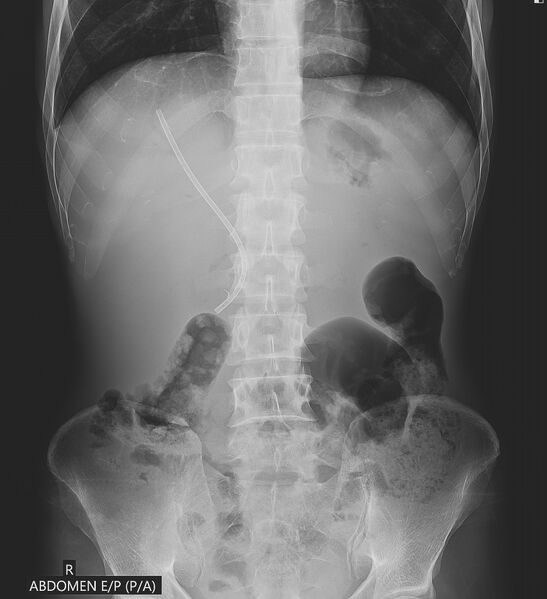 File:Occluded biliary stent (Radiopaedia 87522).jpg
