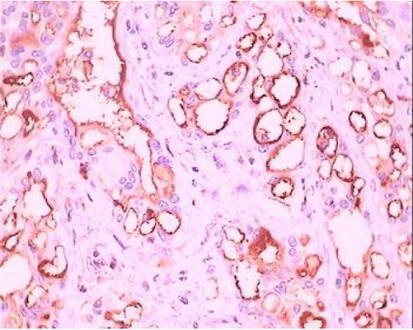 Adenomatoid tumor with cells performing positive immunoreactivity to HMBE1-index of mesothelial origin