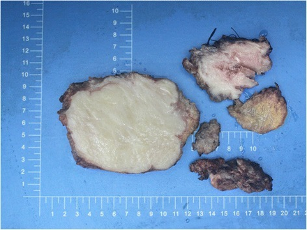 Macroscopically, desmoid tumors were yellowish white on the cut and often poorly circumscribed