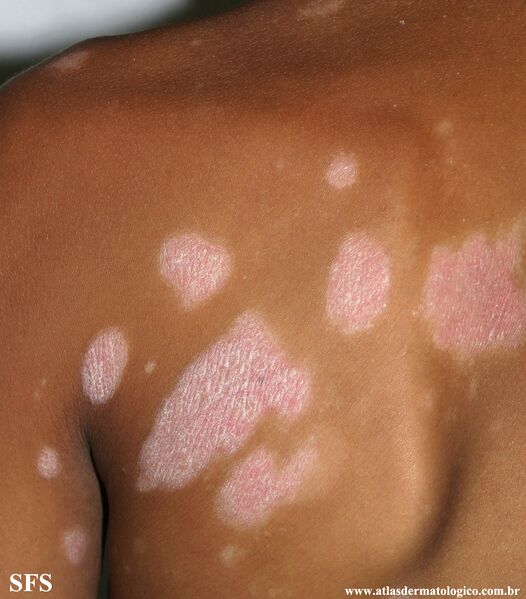 File:Psoriasis (Dermatology Atlas 87).jpg