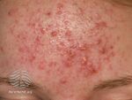 Rosacea (DermNet NZ acne-red-face-3634).jpg